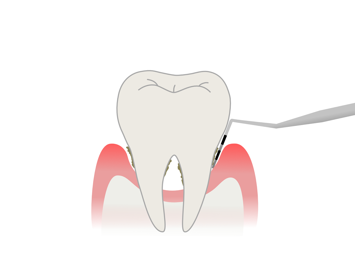 【徹底解説】歯周ポケットとは？深さ、症状、対策方法 – 歯周病の進行防止策