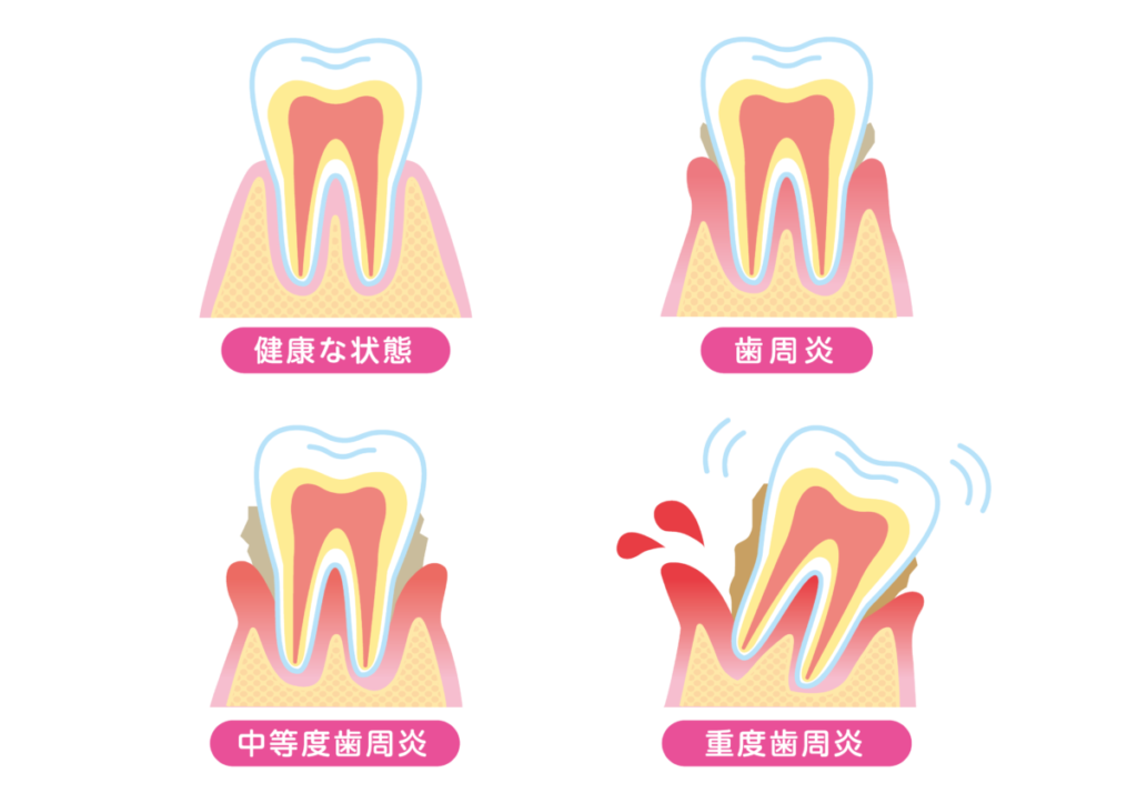歯肉炎・歯周炎・歯周病の違い