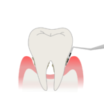【徹底解説】歯周ポケットとは？深さ、症状、対策方法 – 歯周病の進行防止策