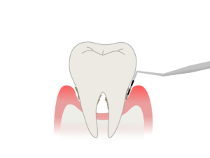 【徹底解説】歯周ポケットとは？深さ、症状、対策方法 – 歯周病の進行防止策