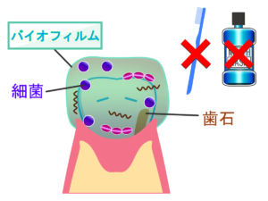 バイオフィルムとは　歯科や自宅で行う除去方法